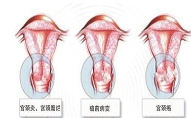 如果有宮頸炎等婦科症狀,就會導致月經不調,相信很多女性對月經不調都