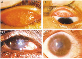 沙眼(trachoma)是由沙眼衣原体(chlamydia)引起的一种慢性传染性结膜