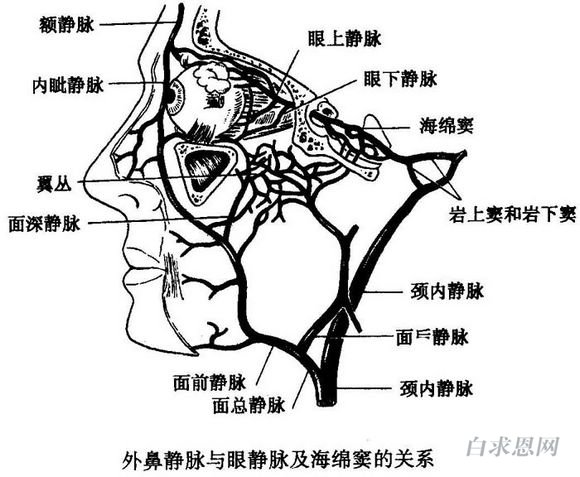 急性海綿竇栓塞性靜脈炎是一種嚴重的海綿竇化膿性炎症